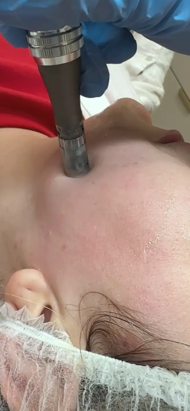 Dermapen w Quality House of Beauty