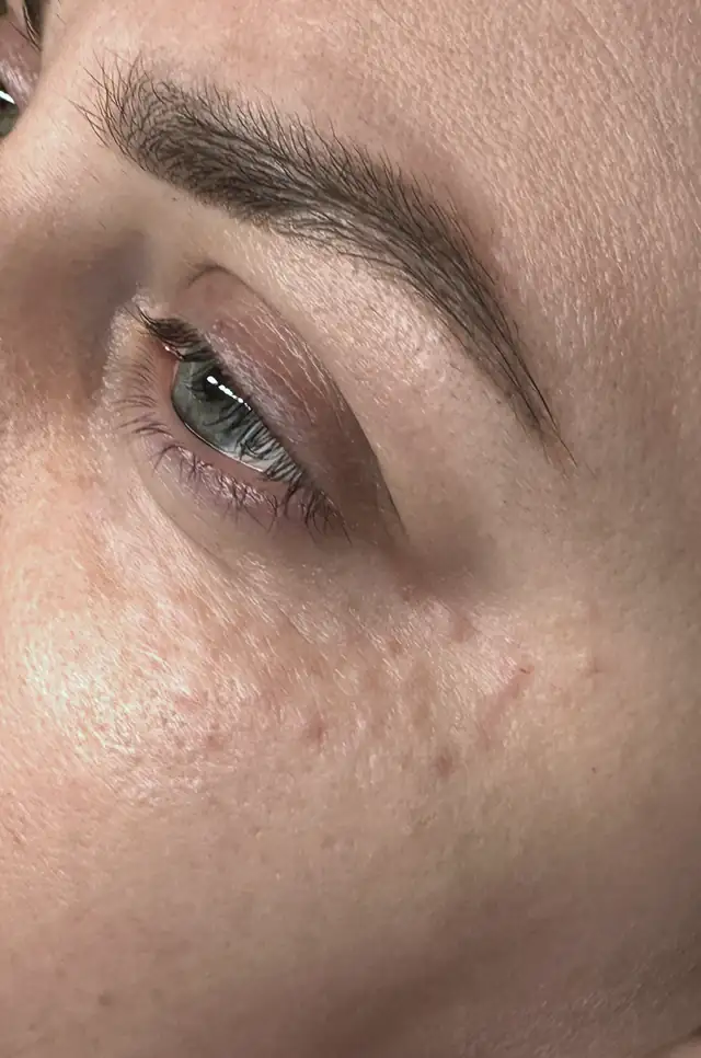 Mezoterapia okolicy oka w Quality House of Beauty
