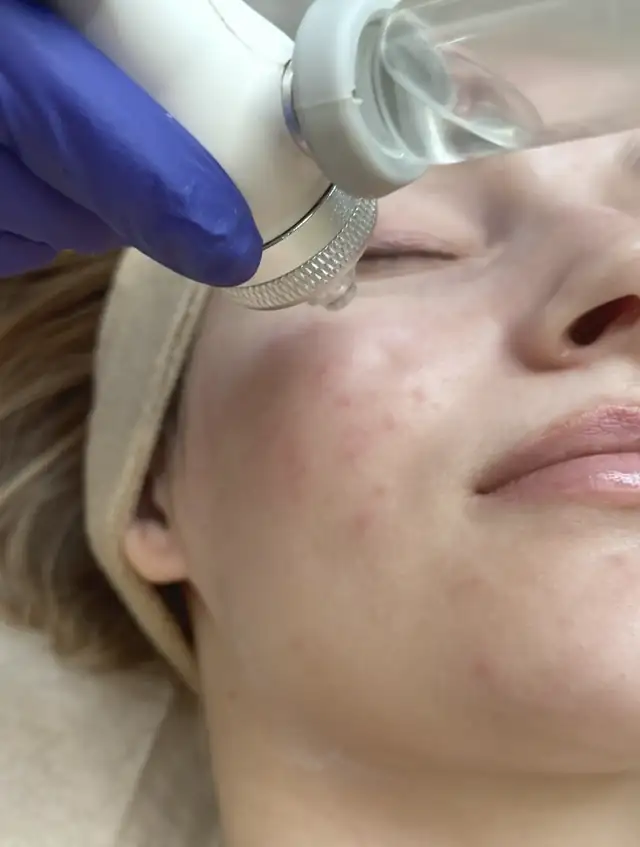 Infuzja Tlenowa/Oxybrazja w Quality House of Beauty